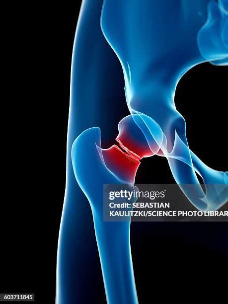 37 Hip Bone Fracture Stock Photos, High-Res Pictures, and Images - Getty Images