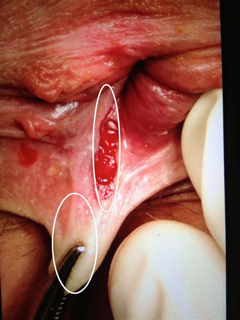 Blog do Saúde Médica Proctologia Fissura anal tratamento laser