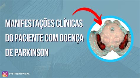 Doença De Parkinson Manifestações Clínicas Youtube