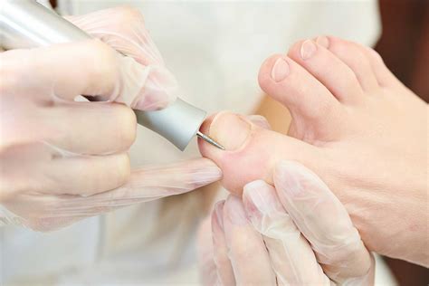 Ingrown Toenails Information And Treatment By Farnham Foot Clinic