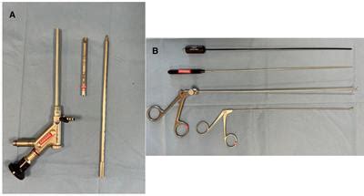 Frontiers Full Endoscopic Removal Of Third Ventricular Colloid Cysts