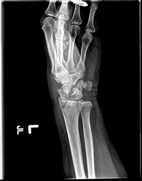 [figure Interarticular Distal Radius Fracture Contributed By Russell A Reeves Md Ms