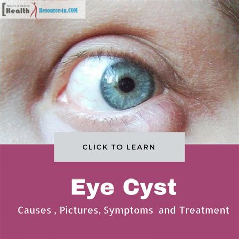 Eye Cyst Causes Symptoms Removal Pictures And Treatment