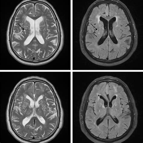 Schematic Representation Of Perivascular Spaces Pvs Indirectly