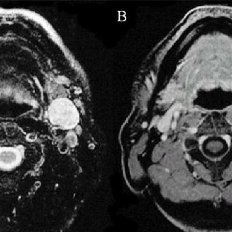 A Axial Fat Suppressed T Weighted Spin Echo Image And B Axial Fat