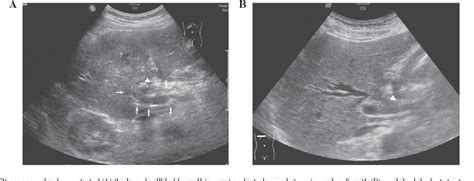 Figure From Chronic Cholecystitis With Hilar Bile Duct Stricture