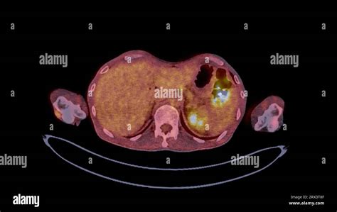 Imagen Pet Ct De Todo El Cuerpo Humano Plano Axial Coronal Y Sagital