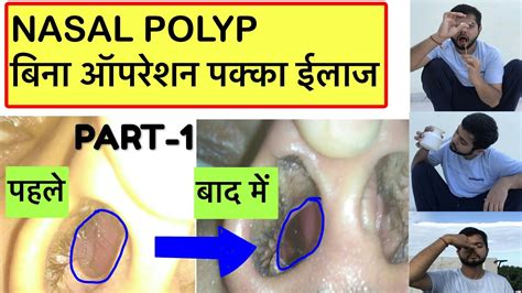 Nasal Polyps 10 Symptoms Of Nasal Polyps