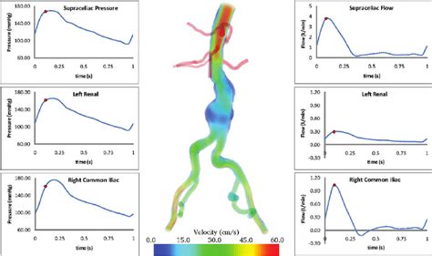 Preoperative Cfd Analysis Of Patient Specific Computer Model Aortic