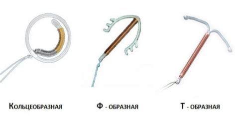 Как устанавливают спираль