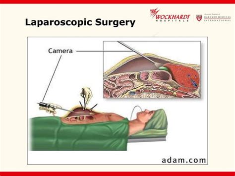 Single Incision Laparoscopic Surgery Ppt