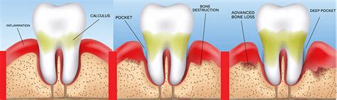 Plaque Calculus Tartar Gum Disease What Do These All Mean