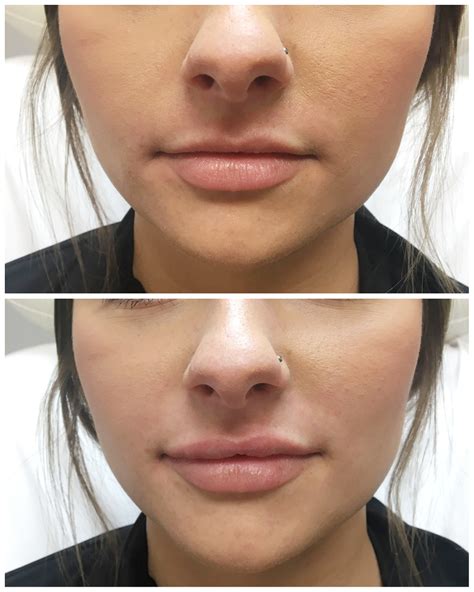 RHA Collection Of Fillers Seiler Skin