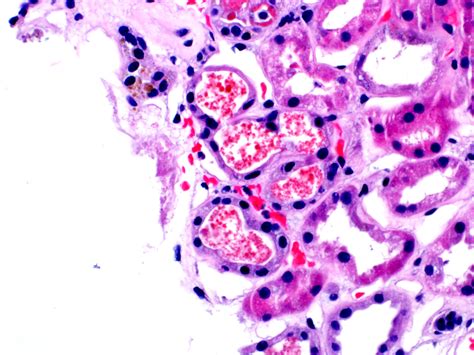 #PathPointer: Casts Give Us Clues – Pigmented Granular Casts on Kidney ...