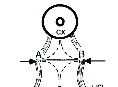 Approximation Of Uterosacral Ligaments Usl 9 A 5cm Long