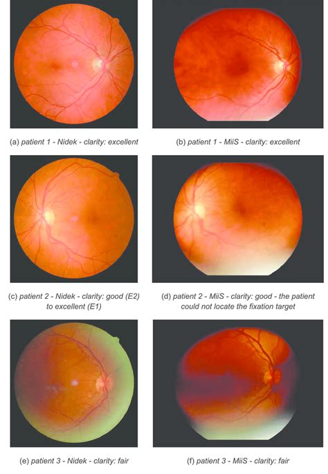 Typical successful photographs obtained with R1 and R2. Patient 1 had ...