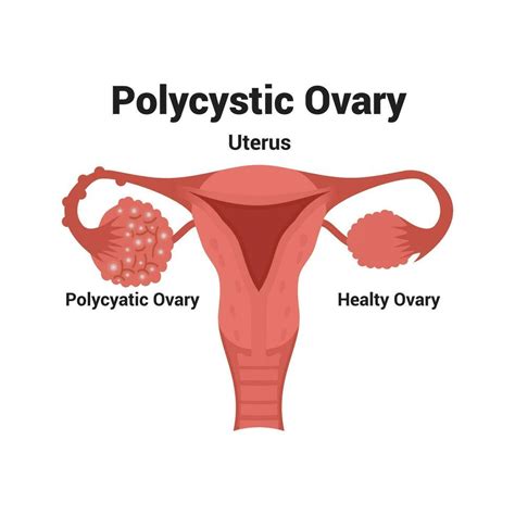 Illustration Of Polycystic Ovary Vector 25659223 Vector Art At Vecteezy