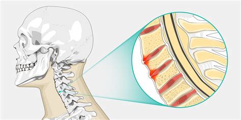 Spondylosis Treatment Cess Center Of Excellence In Spine Surgery