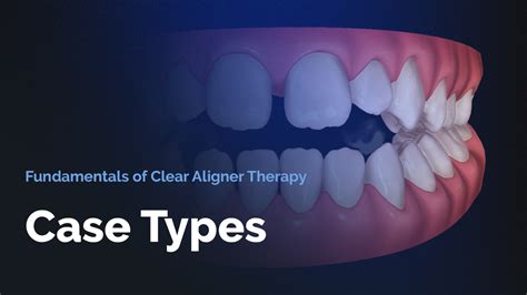 Fundamentals Of Clear Aligner Therapy Exploring Case Types Invisalign Immersion