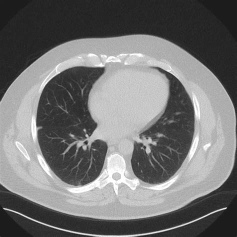 Hrct Scan In Delhi Best Hrct Scan Centre Hrct Chest Test