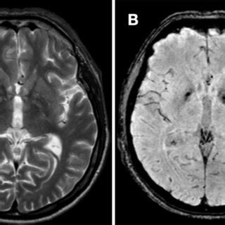 Magnetic resonance imaging (MRI) of the encephalon. A) T2 with ...