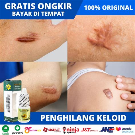 Propolis Asli Original Obat Keloid Menonjol Tahunan Obat Bekas Luka