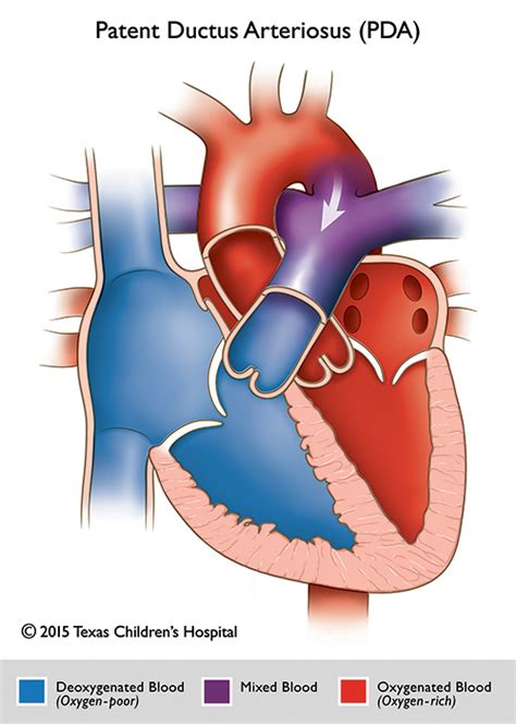 Patent Ductus Arteriosus