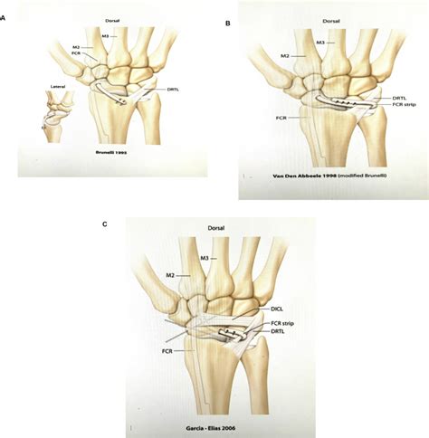 Management Of Chronic Scapholunate Ligament Injury Journal Of