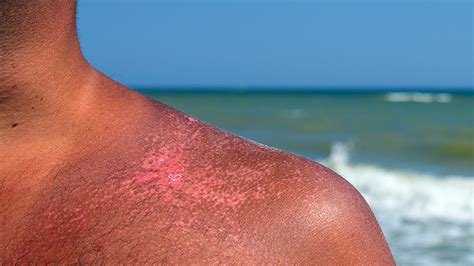 8 Ways To Treat Sunburn At Home General Health Magazine