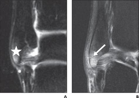 Figure From Bone Marrow Edema Patterns In The Ankle And Hindfoot