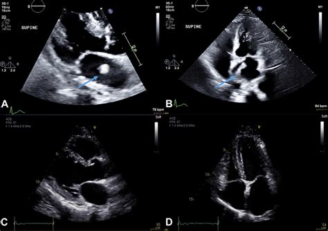 Transthoracic Echocardiogram Showing The Parasternal Long Axis Left