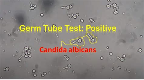 Germ Tube Test Positive Candida Youtube