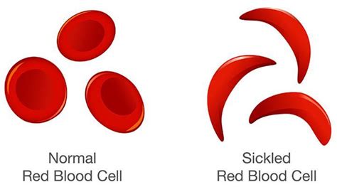 Fda Approves Revolutionary Cell Based Gene Therapies For Sickle Cell