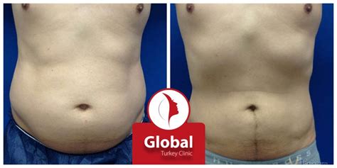 Abdominoplastie