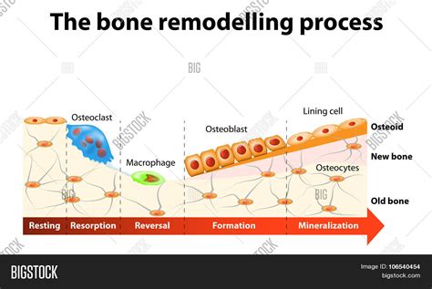 Bone Remodelling Vector & Photo (Free Trial) | Bigstock