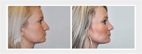 Dr Michael Zacharia Dr Zacharia Restructure Your Nose With Nose Surgery