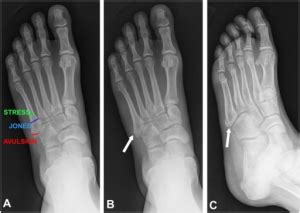 Fifth Metatarsal Avulsion Fracture