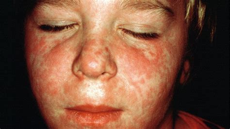 Why Is The Uk Seeing A Rise In Measles Cases Bbc News