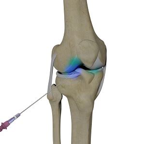 Intraarticluar Knee Injection Aspen Rheumatoid Arthritis Basalt