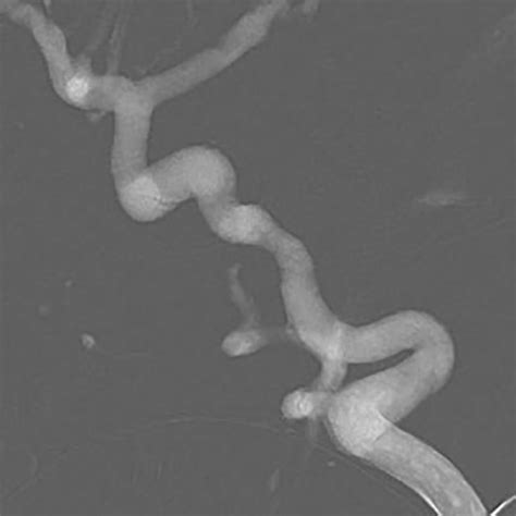 Percutaneous coil embolization of vein of Galen aneurysmal malformation ...