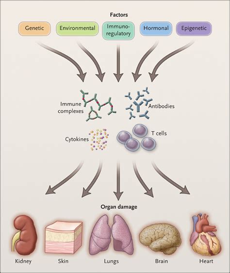 Systemic Lupus Erythematosus New England Journal Of Medicine