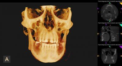 Tomografia komputerowa CBCT także w laryngologii