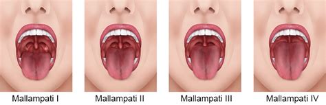 Mallampati Score to Help Predict Obstructive Sleep Apnea in Beverly Hills