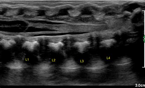 Caudal Regression Syndrome Ultrasound