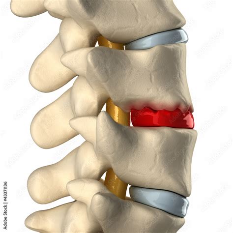 Disc Degeneration By Osteophyte Formation Lateral View Stock Illustration Adobe Stock