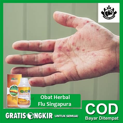 Jual Obat Herbal Flu Singapura Penyakit Tangan Kaki Dan Mulut Ruam