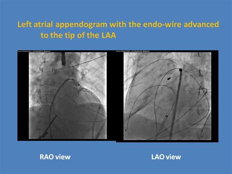 Percutaneous Left Atrial Appendage Ligation With Lariat 严道医声网