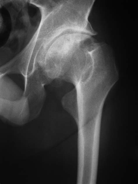 Delayed Transient Sciatic Nerve Palsy After Primary Cementless Hip