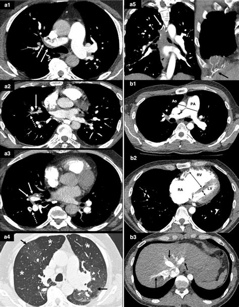 Computed Tomography Pulmonary Angiography Ctpa Images Show 2 Main