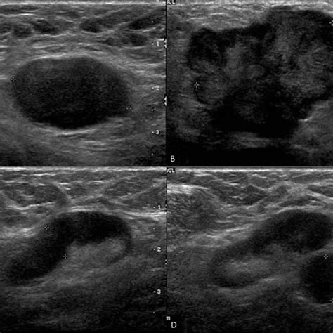 B-mode US and SWE images of a biopsy-proven metastatic lymph node in a ...